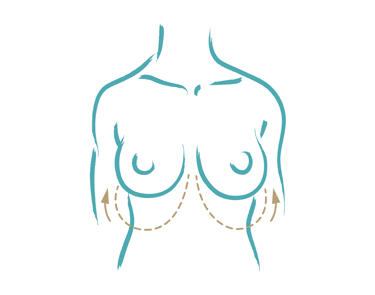 ¿Qué se consigue con una mamoplastia reductiva (reducción de mamas)?